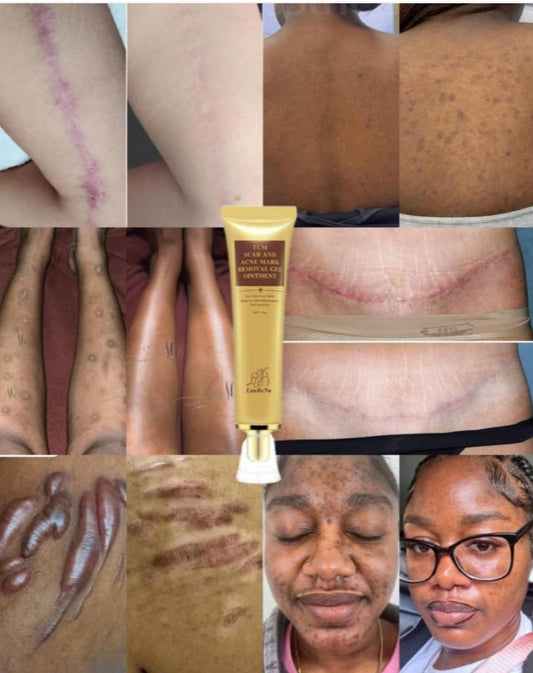 ✨ BUY 1 GET 1 FREE
LANBENA TCM Cream
✅ Reduces stretch marks
✅Treats acne
✅ Fades scars